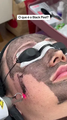 Black Peel✨ O TRATAMENTO QUE VOCÊ PRECISA CONHECER! Quem falar que não quer melhorar a aparência de sua pele, ESTÁ MENTINDO! Todo mundo quer melhorar de alguma formar, e a pele está sempre no ranking da lista de desejos - Minimiza os poros? SIM! - Suaviza a textura da pele? SIM! - Controla a oleosidade? SIM! -Reduz linhas finas? SIM! #blackpeel #hollywoodpeel #peeling #luxurylife 