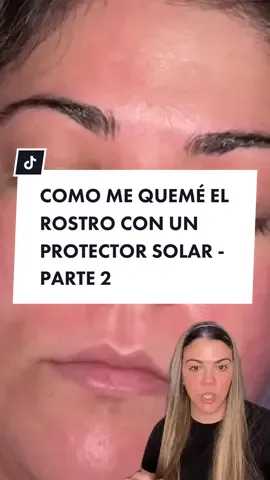 Este video lo hago por que me siento en el compromiso de compartir lo que me pasó con un producto que puede ocasionarle lo mismo a otra persona y que de usarlo sepa que si esta sintiendo lo mismo debe quitarselo para evitar quemaduras! AMO con locura esta marca y no quiere decir que este producto sea malo, me cayó mal A MI, solo quiero informar y crear conciencia a creadores de contenido para que primero prueben los productos antes de recomendarlos y siempre indicar que tipos de pieles pueden usarlo, yo probé este producto bajo mi propio riesgo, pieles sensibles NO LO USEN! 🇺🇸 I am making this video because I feel committed to share what happened to me with a product that can cause the same to someone else and that if you use it you know that if you are feeling the same you should remove it to avoid burns! I LOVE this brand with madness and it doesn't mean that this product is bad, it was bad for ME, I just want to inform and create awareness to content creators to first test the products before recommending them and always indicate what skin types can use it, I tested this product at my own risk, sensitive skin DO NOT USE IT! #viral #quemada #fy #fyp 