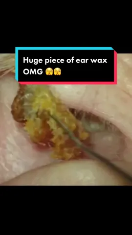 What a huge piece of ear wax.. 🫣🫣 #limpezadeouvido #earwaxcleaning #earcleaning #earwaxremoval #ceradeouvido 
