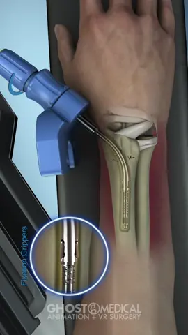 Sonoma WRX Wrist Fracture Repair Device is a Minimally Invasive, Intramedullary Device For Distal Radius Fragility Fractures. Ghost Medical Animation + VR Surgery created a medical animation in 2012 to showcase the surgical methods of the repair process. #bonefracture #wristpain #medicaltiktok #processvideo #awareness 