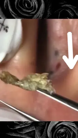#anime #acne #blackheadextractions #asmr #satysfying #extractions #squeezeyuk #pimple 