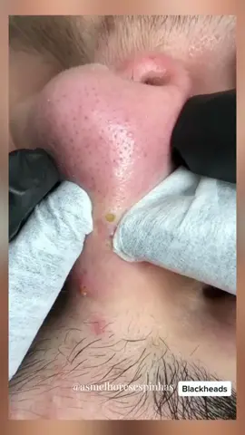 #blackhead #pimple #pimplepop #foryou #espinhas #cravoseespinhas #extractions #satisfying 