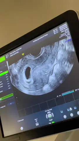 First heart beat appointment 😍 #heartbeat #6weekspregnant #ultrasound 