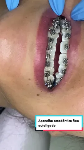 Instalação de aparelho ortodôntico fixo autoligado ✨  #aparelhoortodontico #ortodontia #aparelho #dentista #cordeborrachinha #cordeborrachinhadeaparelho #borrachinhadeaparelho 