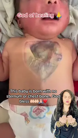 God bless this little baby who is born with a very rare condition no sternum or chest bone#godbless #sternum #highpower19 