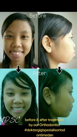 Before orthodontic treatment (behel): Kasus Bimaxillary Prognathism + Dental Protrusion. Profil wajah terlihat konveks / maju pada rahang atas dan bawah. Selain itu, kondisi giginya berjejal / bertumpuk (sehingga kelihatan tonggos) After orthodontic treatment oleh Drg Specialist Orthodontist kami: Profil wajah menjadi lebih tirus & konveksitas profil wajah lebih mundur, sehingga senyum pun jadi lebih percaya diri 😁😊#behelmedan #beforeandafter #medandentalspecialistcenter #medanreview #medantalk #doktergigimedan #doktergigimedan #behelmedan #doktergigispesialisortodontimedan