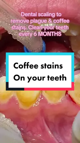 #coffeestains #dentalscaling #dentistsoftiktok #dentalhygienist #scaling #teethwhitening #teethcleaning 