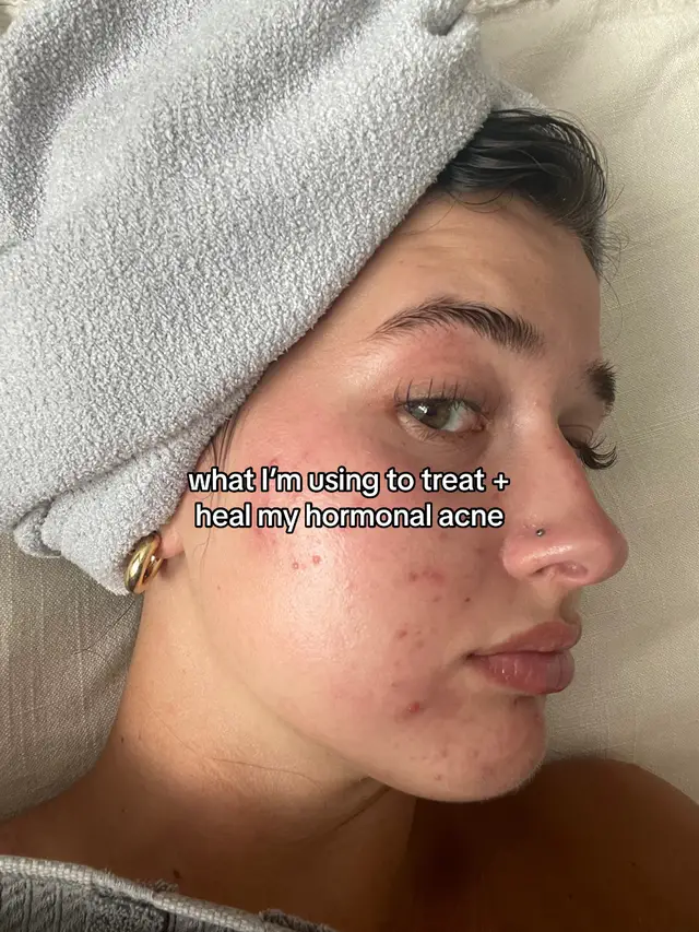 less is more when you’re trying to heal your acne! I’ve already learned so much through this journey - comment with any questions you have 🙊 #acne #spironolactone #tretinoin #retinoids #guthealth #synbiotic @Nurxapp @CeraVe @belif @Seed 