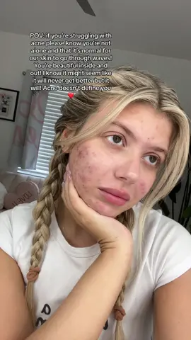 Feeling super vulnerable posting a video like this as my acne is a huge insecurity at the moment. I’ve never had a flare up like this before but want to spread awareness that you’re not alone and acne doesnt define you! I love you all ❤️ #acne #acnepositivity #beautiful 