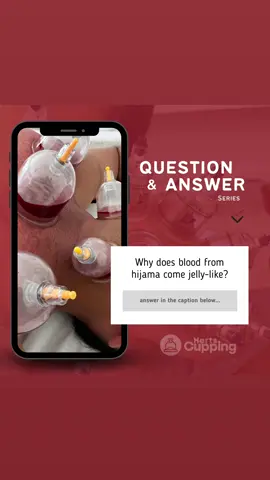 During a hijama session, many people comment intriguingly why the blood 🩸 extracted had a unique jelly-like consistency. There are several reasons behind this fascinating phenomenon: 🌟 Fibrin Formation: The suction applied during hijama cupping can stimulate the release of fibrinogen, a protein involved in blood clotting. This can lead to the formation of fibrin, resulting in the jelly-like appearance of the extracted blood.  🌟 Release of Stagnation and Toxins: Hijama cupping promotes blood circulation and helps eliminate stagnant blood that may contain toxins, metabolic waste, and cellular debris. The presence of these substances can contribute to the unique texture of the extracted blood.  🌟 Tissue Fluid and Extracellular Matrix: The negative pressure created by cupping draws not only blood but also tissue fluid and components of the extracellular matrix. This combination of fluids can affect the consistency and give the extracted fluid a jelly-like appearance.  🌟 Viscosity Variation: Blood viscosity varies among individuals, influenced by factors such as hydration, diet, and overall health. Higher viscosity levels can result in blood that appears thicker and more gel-like during the cupping process.  🌟 Individual Differences and Health Conditions: Each person’s body and health condition are unique, which can contribute to variations in the characteristics of their blood. Certain health conditions or blood disorders may affect clotting and contribute to the jelly-like consistency.  Remember, this jelly-like appearance of blood during hijama cupping is generally considered normal Have you experienced the unique jelly-like blood during cupping?  comment below! ✨💬 @hertscupping ✅ - Like | Share #hertscupping #hijama  #HijamaCupping #RejuvenationJourney #RevitalisedFeeling #JellyLikeBlood #FibrinFormation #BloodCirculation #Detoxification  #extracellularmatrix #BloodViscosity #IndividualDifferences #PositiveVibes #WellnessJourney #HealthAndWellbeing  #HolisticHealing #NaturalTherapies #EmbraceTheWonders #MindBodyConnection #SelfCare #HealthTips #HolisticLiving #EmpowerYourself #HealthAwareness #BodyMindSpirit #PositiveLiving 