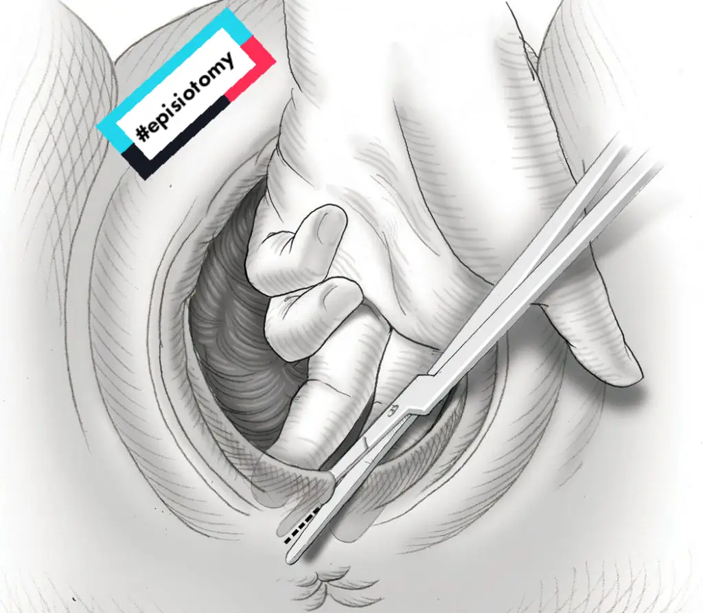 ##episiotomy #grossese #acouchment #شق_العجان #الغراز 