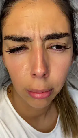 Veja esse antes e depois #rugasemarcasdeexpressao #glabela #botoxglabela #toxinabotulinica #botoxpreventivo #botoxday #mesobotox #beautytouchbyju #esteticaavancada #beleza #esteticafacial 