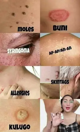 LAHAT NG PROBLEMA SA SKIN NAGAGAMOT NITO! #wartsremoval #wartstreatment #molesremoval #skinproblem #fyp #fypシ #fypage #foryoupage #foryouph #tiktokaffiliate #budol #MomsofTikTok 
