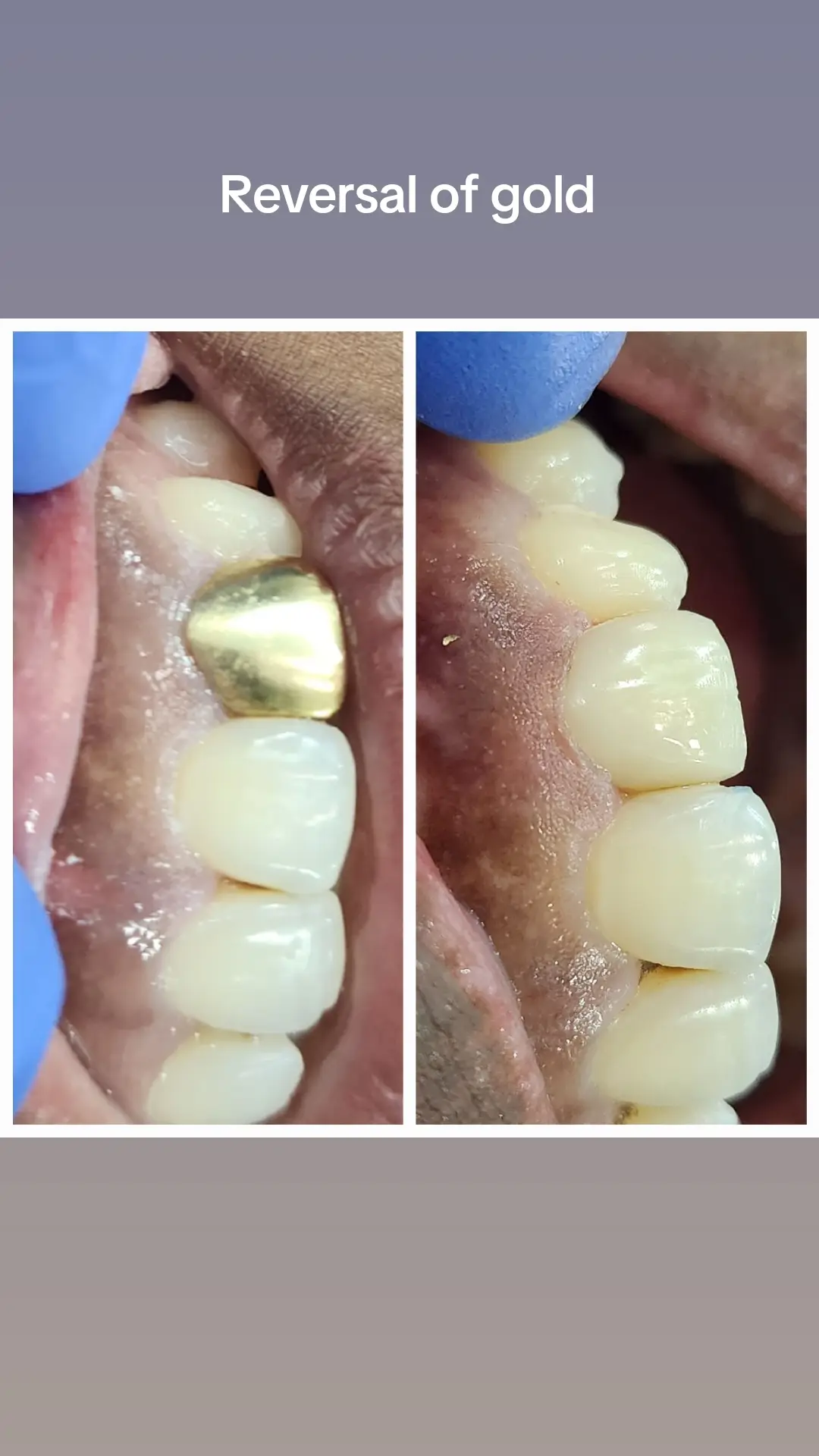 #biomimeticdentistry #veneers #durban #dentist 