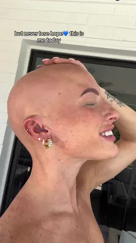 I ised to fight trying to grt my hair to grow back but this is the reason why I stopped all treatment for my hairloss. It impacted me way worse than just accepting my bald head #alopecia #inspiration #selflove #baldgirl #atrophy #hairloss #baldgirl #chl0ebean #hairlosstreatment #fyp #foryoupage #alopeciaareata #empowerment #alopeciaawareness 