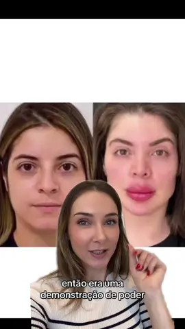 #gkay #padraodebeleza #estetica #harmonizacaofacial #hialuronidase #acidohialuronico #botox #antesedepois 