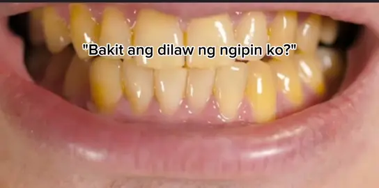 Madilaw na ngipin, no more. 😁🥰💯