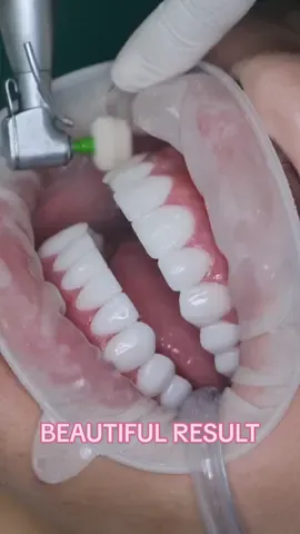 Brighter Smile is an unforgettable experience, from start to finish.  We work with all types of dental procedures as well in addition.  Any questions❓send us a private message for more information for a free consultation, we will respond to all of your questions, it’s our pleasure to help you understand about our work! Don’t hesitate to ask us 😉   #porcelainveneers 🦷  #colombia #dominicanrepublic #fyp #minimalprepveneers #nonprepveneers #teeth #trending 