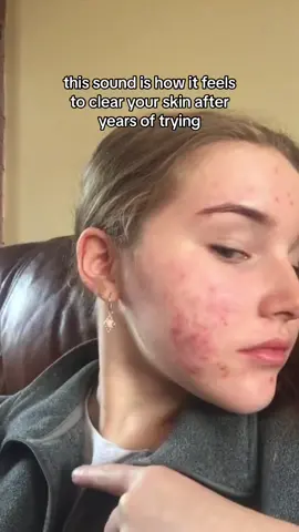 acne guides in bio! keep going angels❤️‍🩹❤️‍🩹 im reminding myself this evening that healing is not linear!!! #acne #skincare #skintransformation #acneskin #acnetok 