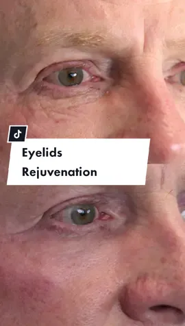 This gentleman came to me for a nonsurgical treatment of his aged skin in his upper and lower eyelids. Utilizing the CO2 laser with proper settings gives amazing results for aging skin around the eyes and fine wrinkles. This particular patient was offered a surgical Browlift to elevate his descending brows but opted for laser only since his concern was his lower eyelid wrinkles only. This was performed under local anesthesia. #co2laser #eyelidlift #lowereyelid #skintightening 