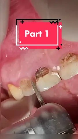 Deep caries #dentist #dentista #dental #dentistry #fyp #viral 
