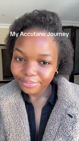 I was hesitant but…this was the best decision! *the before photos are from a year ago* and yes I have freckles so skincare is important! If you want tips on how I am maintaining my skin, let me know! 🙌🏼☀️✨🌼 #skincare #realskintexture #accutanejourney #accutanecheck #skincaretips #skincareroutine #accutanetips #accutaneresults #skintextureisnormal #clearskintips #skinchecks #greenscreen 