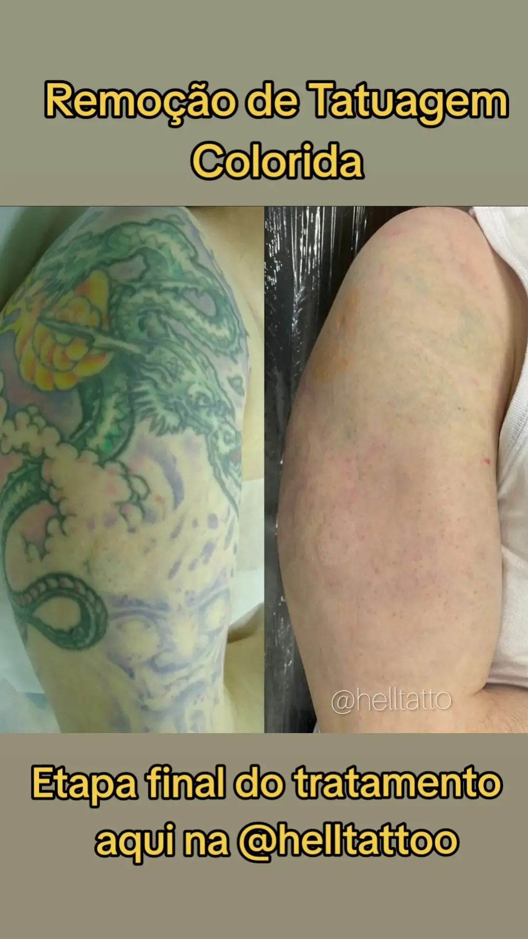 Etapa final do tratamento de remocaonde tatuagem colorida com laser PicoSure,  Spectra XT e Picoway.  somos o maior Polo tecnológico dedicado a remoção de tatuagens de todo o Brasil 🇧🇷⚡️ #tatuagemoriental #tatuagem #remocaodetatuagem 