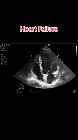Heart Failure#echocardiogram #heart #jantung #heartdisease #fyp #ijn #hf #heartfailure 