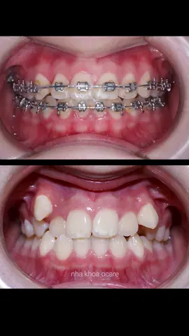 Nghỉ dịch hơi lâu nên phải mất hơn 3 năm mới hoàn tất #niengrang #nhakhoa #braces #orthodontist