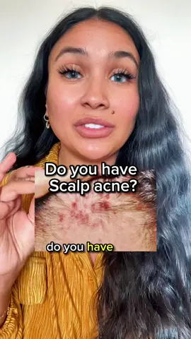 ✅ Scalp acne 101 #hair #hairtok #LearnOnTikTok #fyp #scalpacne 