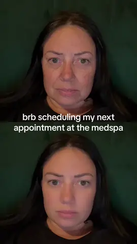 #botox 