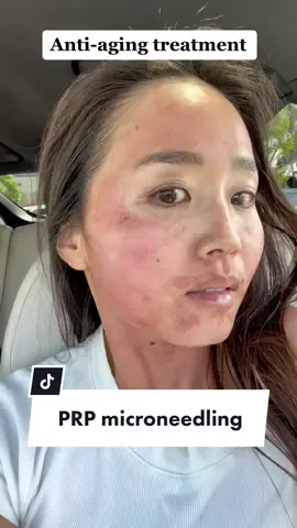 Come get PRP microneedling with me❤️ it was so painful but hopefully its all worth it🥹 #prpmicroneedling #PRP #antiaging #stayyoung #skincare #beautyprocedures #facial #vampirefacial #glowyskin #flawlessskin 