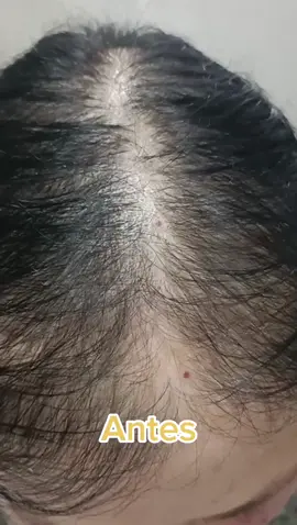 😍🕵️Caso Clínico Alopecia Androgenética! #quedadecabelo  #tratamentocapilar  #vitaminascapilares  #alopeciafeminina  #quedacapilarfeminina 