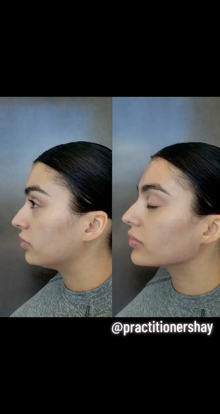 Facial Balancing using dermal fillers & Botox! #faciabalancing #cheekfiller #lipsbyshay #cheek #miamifiller #dermalfillers #injectables #chinfiller #fillersnearme #fyp #explorepage #selfie #juvederm #beforeandafter #explore #sideprofile #obsessed #Love #facial #skincare #beauty #influencer #medspa #antiaging #poutylips #miami 