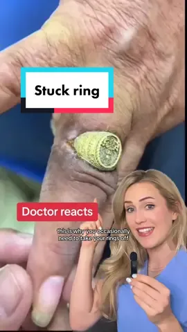 Til death do they part 😳 #ring #funfact #healthfacts #doctor #doctors #doctorsoftiktok #medicine #medical #medicalhumor #medicalvideos #surgery #nurse #nurses #podiatry #podiatrist #podiatric #surgeon #surgeons #healthcare #scrublife 
