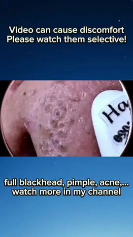 Big pimple blackhead removal #acne #pimple #blackhead #extractions #satisfyingvideo