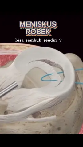 #meniscustear @WM.CENTER #fisioterapi #fisioterapi #wmcenter #windymayang #infokesehatan #fypシ 