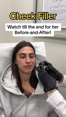 When injected by an expert, hyaluronic acid dermal fillers will turn back the clock by restoring lost volume, smoothing fine lines, softening creases, and enhancing facial contours. Can last up to 12 months with no down time. Our goal is to maintain a subtle, youthful, and more refreshed look rather than an obvious change to your already beautiful appearance!  Contact us Today!  📞416-861-8600 ✉️info@fcpdermatology.com #fyp #toronto #torontolife #fypシ #fypviralシ #foryou #botox #filler #syringe #viral #juvederm #cheek #belkyra #dermatology #foryoupage #beforeandafter #barbie #barbiegirl 