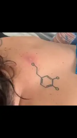 #extractionslovers #pimple #espinhas #extractions #tiktok #foryou #skincareroutine 