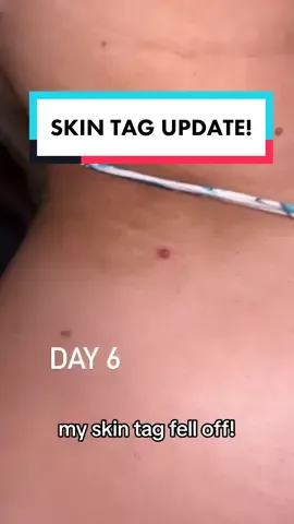 1 week skin tag update! Check out the results 😍 #tagband #beforeafter #skintag #satisfying #skintagremoval 