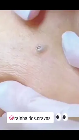 #TikTokBeleza #acnetreatment #viral #satisfyingvideo #blackpimples #videosrelaxantes🌿 #bigpimples #cravosgigantes #extracaodecravos #cravoseespinhas #satisfatorios #pimples #maisvistostiktok #foryou 