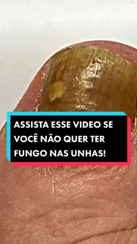 RECEITA MILAGROSA PARA FUNGO NAS UNHAS! 🙀 #receitanatural #saudedamulher #saude #dicasdesaude #emagrecer #emagrecimemto #mulher 