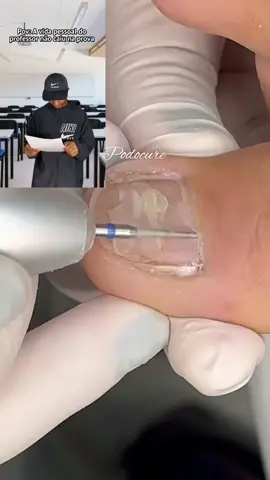 Ib:@Fêfê Bez  #unhaencravada #podologa #podologia #unhas #unhainflamada #professor #prova #materialgirl #unha 