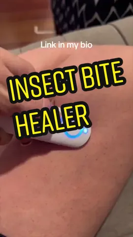 This thing is magic! No more itching! Search insect bite healer on google or use the link in my bio. #insectbitehealer #itchrelief 