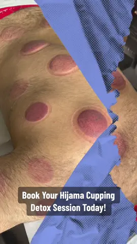 🌟 Embrace the Art of Hijama Cupping Therapy for Total Rejuvenation! 🌟 ✨ Unlock the Healing Power of Hijama at Herts Cupping! ✨ 🍃 Indulge in the Timeless Practice of Hijama Therapy! 🍃 Allow Your Mind and Body to Unwind & Revitalise! 💆‍♂️ 📞 Call/Whatsapp now to Book Your Tranquil Session! 📞 📍 Conveniently Located in St Albans, hertfordshire . . . . #cupping #hijama #detox #cuppingmassage #hijamatherapy  #HijamaCupping #HolisticHealing #WellnessJourney #SelfCare #RelaxationTime #HertsCupping #HealthandWellbeing #HijamaTherapy #NaturalHealing #RejuvenateYourself #naturalhealing #FeelGood #StressRelief #hertscupping #drycupping #wetcupping 