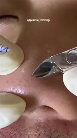 Time to relax 🧘 #blackheads #supersatisfying #extractionsatisfaciton #pimplepop 