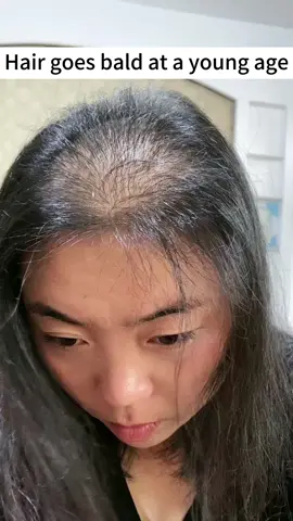 Hair loss is very normal,and baldness also starts from hair loss it is important to take your hair seriously,as it is also a beautiful part #hair #bremodshampooandconditioner #haircare #bremod #fyp #tiktok 