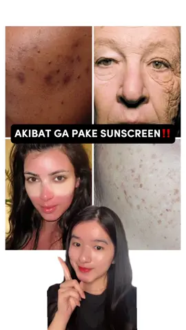 Ini akibat kalo kalian ngga pake sunscreen! Jangan lupa buat selalu pake sunscreen, apalagi pas aktivitas outdoor yaa 💗#rekomendasisunscreen #sunscreen #gayaditiktok #SPFNoGimmick #SolusiDermalPetersons #Petersonslab @Peterson's Lab Official Store #SeSujarFazBem 