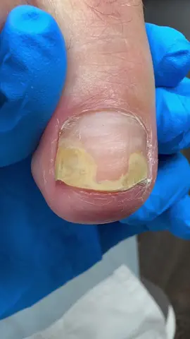 Onycholysis treatment with prosthetic nail reconstruction with the medication for Fungal infection along side. #onycholysis #fungalinfection #fungalnail #pedicure 