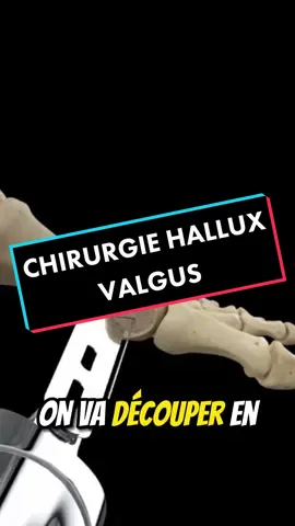 Voilà l’opération de l’hallux valgus 🦶#halluxvalgus #halluxvalgusoperation #chirurgie #medecine #kiné #anatomie #hallux 